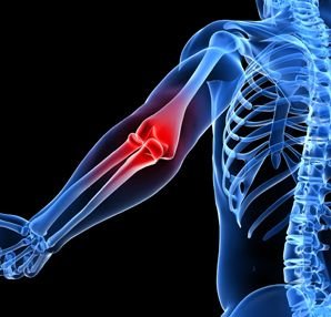 Osteoartrit ( kireçlenme) nedir?